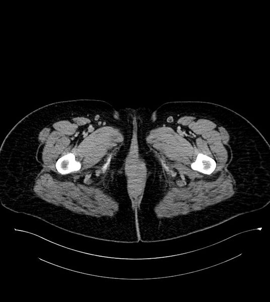 File:Anterior abdominal wall CSF pseudocyst (CSFoma) (Radiopaedia 79453-92571 A 100).jpg