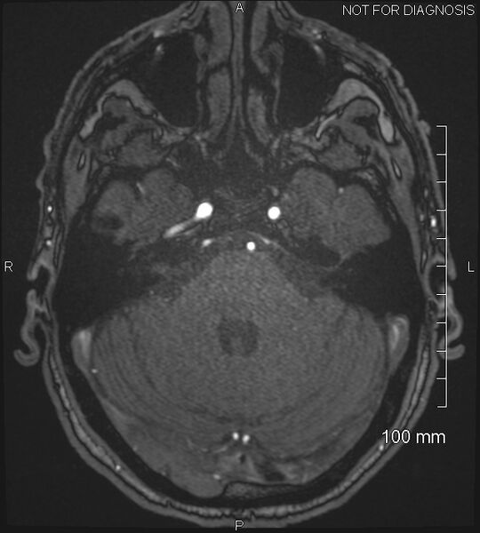 File:Anterior cerebral artery aneurysm (Radiopaedia 80683-94127 Axial MRA 58).jpg