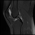 Anterior cruciate ligament tear, Wrisberg rip and bucket-handle tear of medial meniscus (Radiopaedia 75872-87266 Sagittal PD fat sat 14).jpg