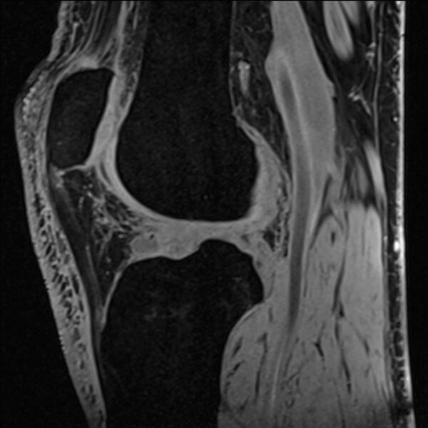 File:Anterior cruciate ligament tear - ramp lesion (Radiopaedia 71883-82322 Sagittal T1 vibe 62).jpg