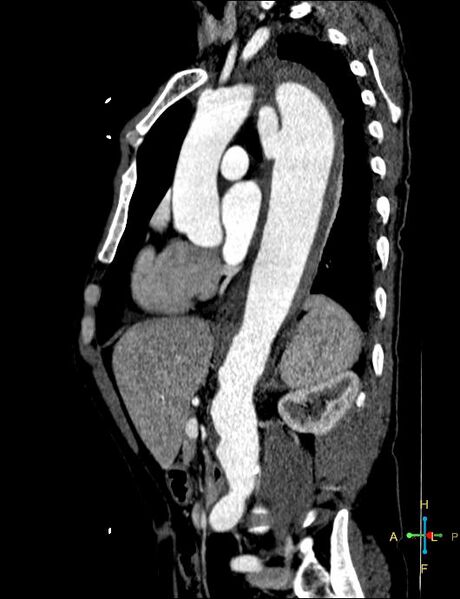 File:Aortic aneurysm and penetrating ulcer (Radiopaedia 23590-23704 C 15).jpg