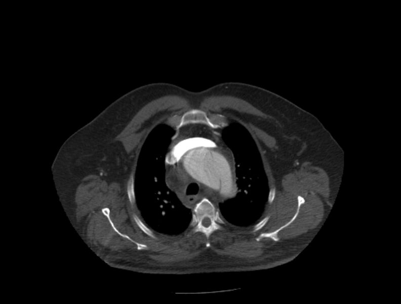 File:Aortic dissection (Radiopaedia 28802-29105 A 5).jpg