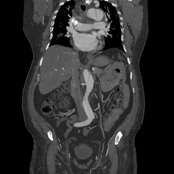 File:Aortic dissection (Radiopaedia 28802-29105 B 16).jpg