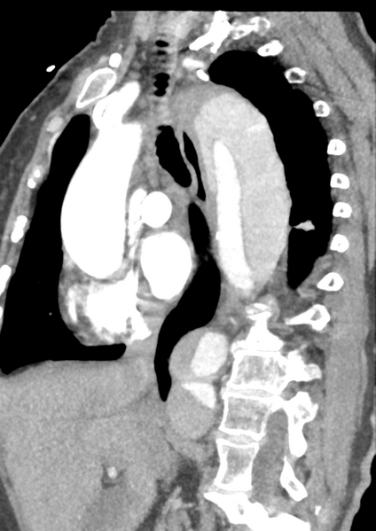 File:Aortic dissection - Stanford type B (Radiopaedia 50171-55512 C 33).png