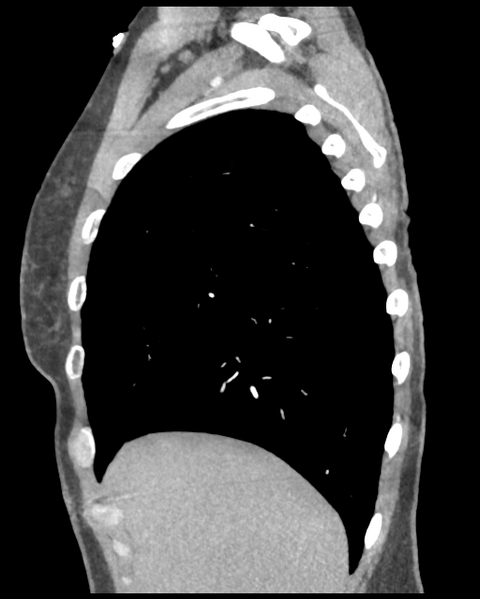 File:Aortic valve non-coronary cusp thrombus (Radiopaedia 55661-62189 D 43).png
