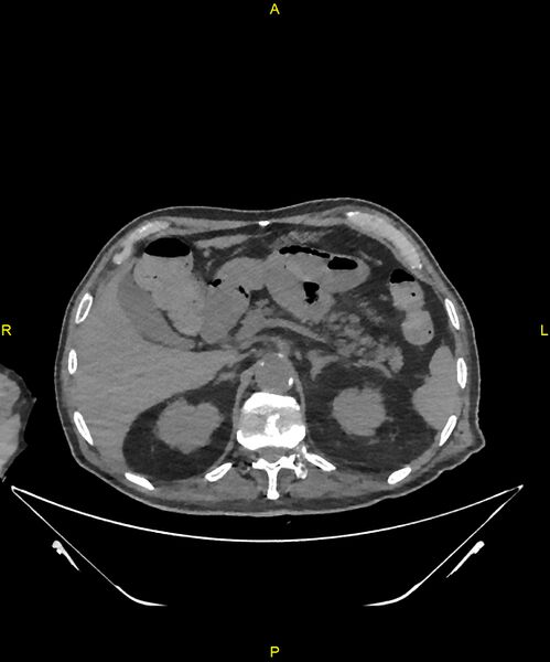 File:Aortoenteric fistula (Radiopaedia 84308-99603 Axial non-contrast 83).jpg