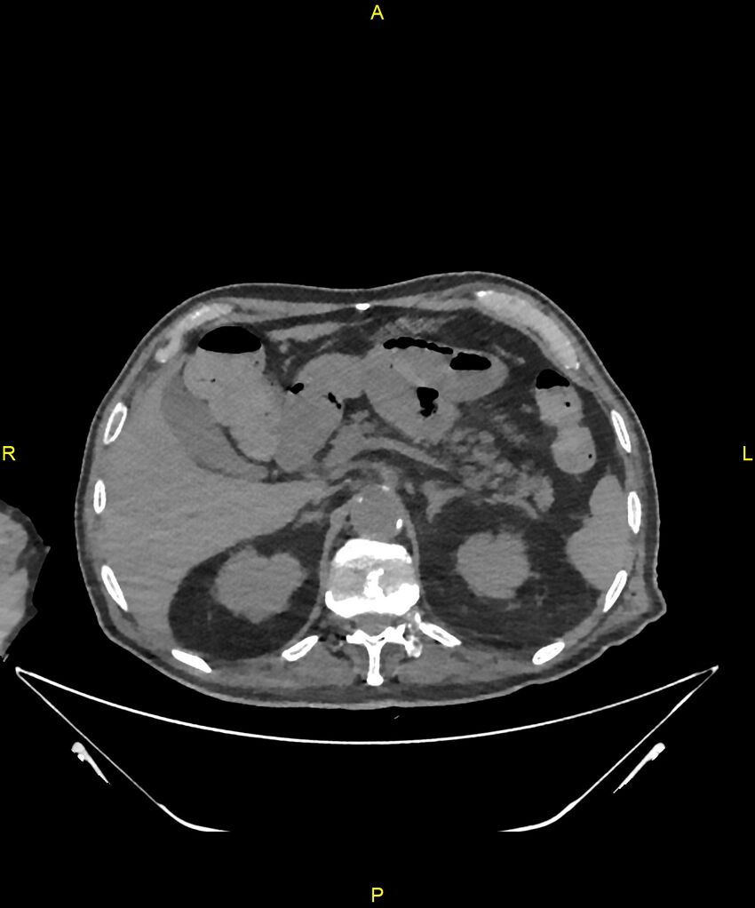Aortoenteric fistula (Radiopaedia 84308-99603 Axial non-contrast 83).jpg