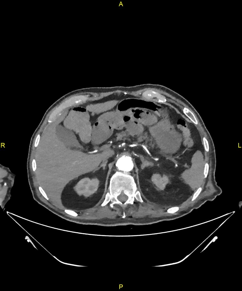 Aortoenteric fistula (Radiopaedia 84308-99603 B 72).jpg