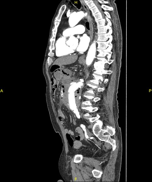 File:Aortoenteric fistula (Radiopaedia 84308-99603 C 198).jpg