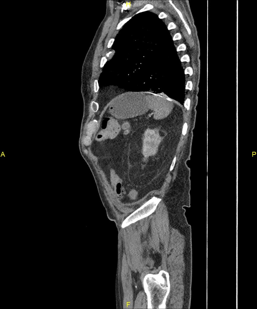 Aortoenteric fistula (Radiopaedia 84308-99603 C 285).jpg