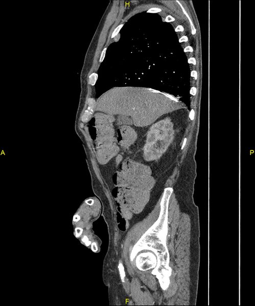 File:Aortoenteric fistula (Radiopaedia 84308-99603 C 89).jpg