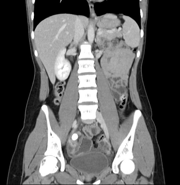File:Appendicitis and incidental bicornuate uterus (Radiopaedia 22833-22853 D 23).jpg