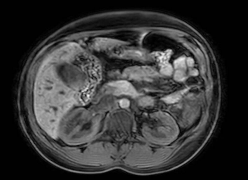 File:Appendicitis in gravida (MRI) (Radiopaedia 89433-106395 Axial DIXON 46).jpg