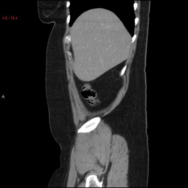 File:Appendicitis with microperforation- promontoric type (Radiopaedia 27268-27442 A 1).jpg