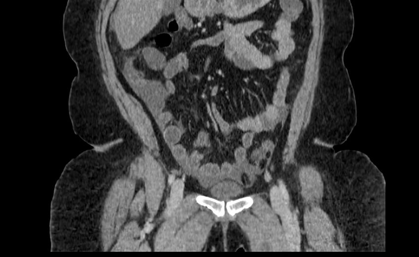 Appendix mucocele (Radiopaedia 41222-44033 B 20).jpg