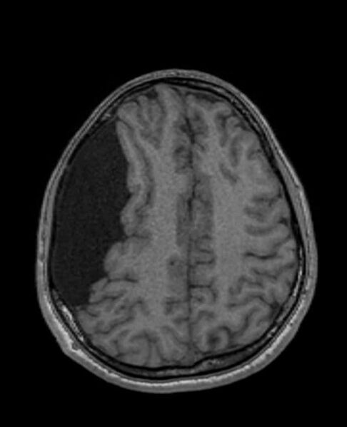 File:Arachnoid cyst- extremely large (Radiopaedia 68741-78451 Axial T1 56).jpg