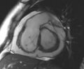 Arrhythmogenic right ventricular cardiomyopathy (Radiopaedia 69431-79307 Short axis cine 169).jpg