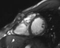 Arrhythmogenic right ventricular cardiomyopathy (Radiopaedia 69564-79464 short axis cine 114).jpg