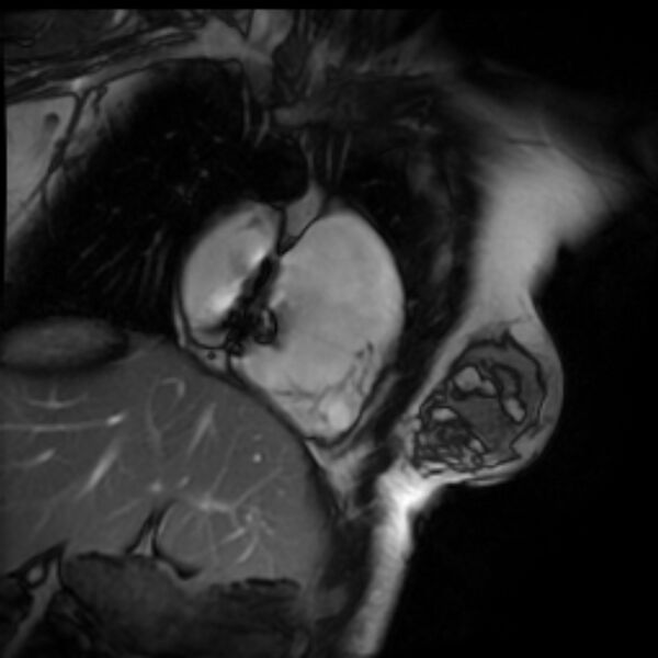 File:Arrhythmogenic right ventricular cardiomyopathy (Radiopaedia 87505-103850 2ch (RV) Cine SSFP 69).jpg
