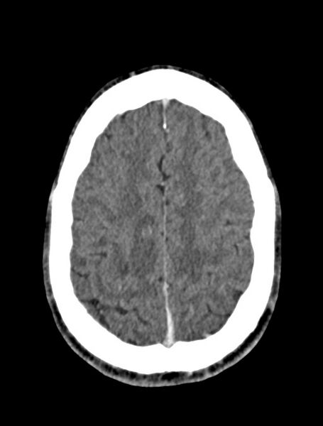File:Arrow injury to the face (Radiopaedia 73267-84011 Axial C+ delayed 69).jpg