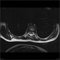 Arthrogryposis and muscle atrophy (Radiopaedia 24081-24314 C 5).jpg