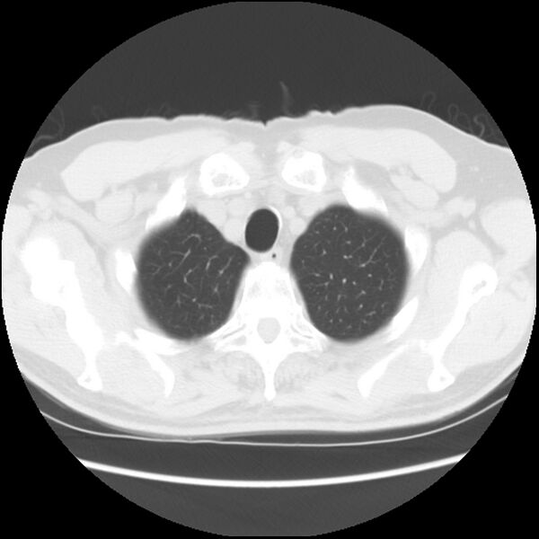File:Asbestos-related pleural plaques (Radiopaedia 39069-41255 Axial lung window 9).jpg