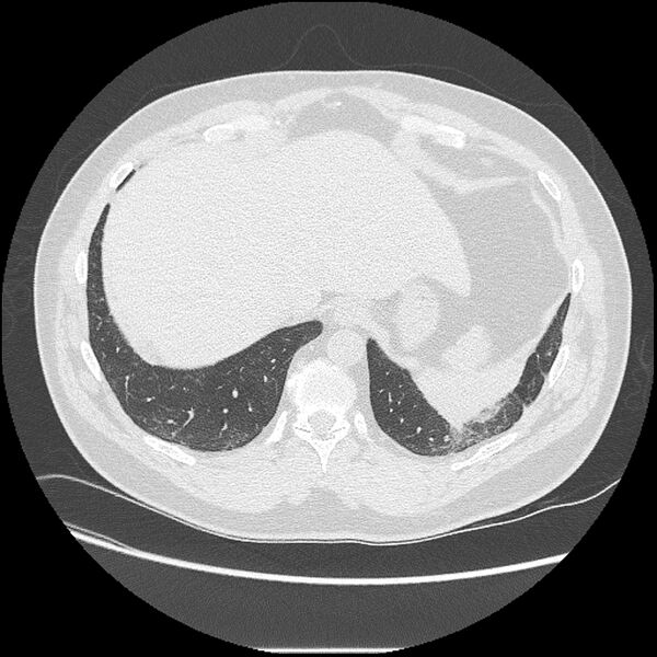 File:Asbestosis (Radiopaedia 45002-48961 Axial lung window 41).jpg