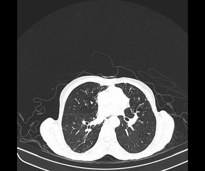 File:Aspergillomas (Radiopaedia 66779-76110 Axial lung window 25).jpg