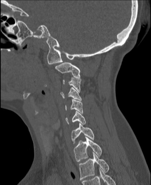 File:Atlanto-occipital assimilation with basilar invagination (Radiopaedia 70122-80188 Sagittal bone window 105).jpg