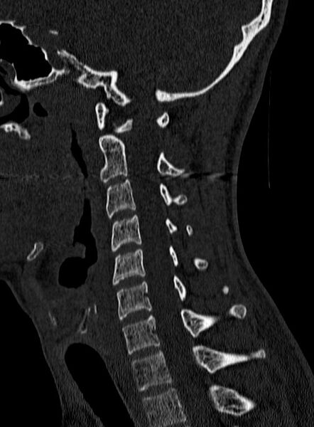 File:Atlantoaxial subluxation (Radiopaedia 44681-48450 Sagittal bone window 92).jpg