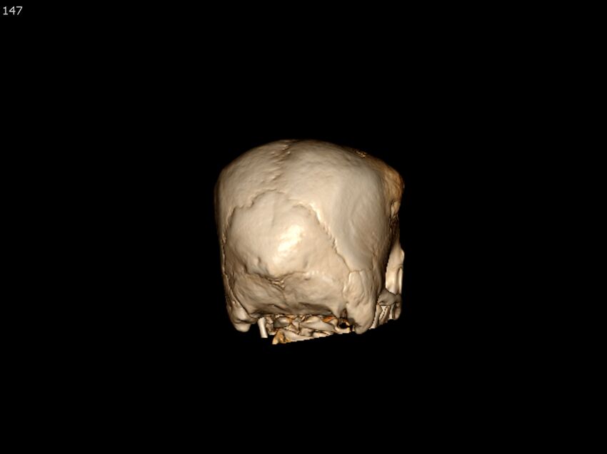 Atypical meningioma - intraosseous (Radiopaedia 64915-73867 3D volume render 147).jpg