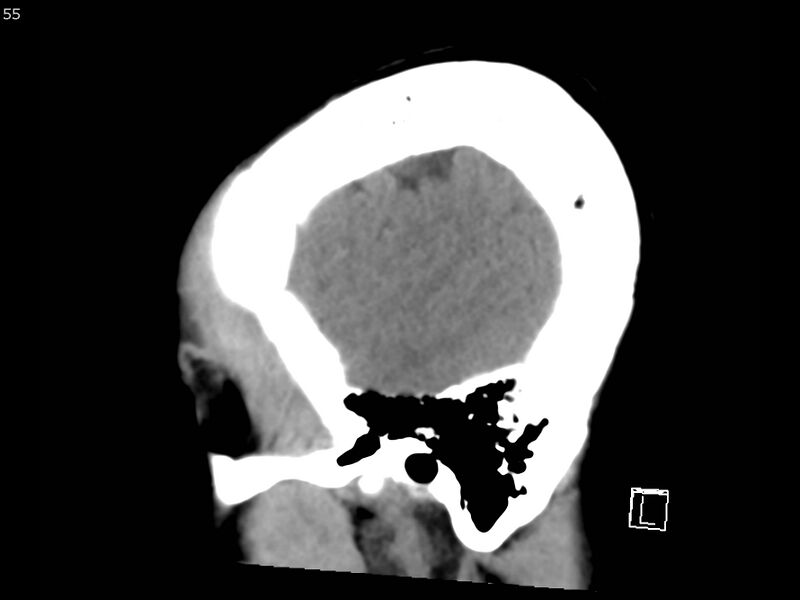 File:Atypical meningioma - intraosseous (Radiopaedia 64915-73867 C 53).jpg