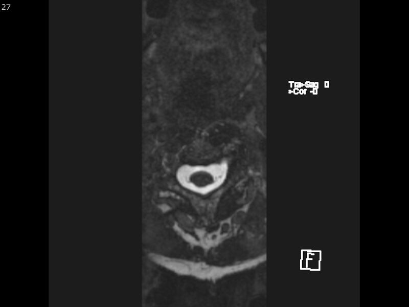 File:Atypical meningioma - intraosseous (Radiopaedia 64915-74572 Axial CISS 27).jpg