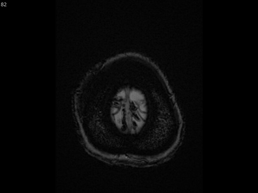 Atypical meningioma - intraosseous (Radiopaedia 64915-74572 Axial SWI 82).jpg