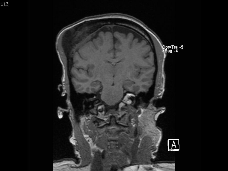 File:Atypical meningioma - intraosseous (Radiopaedia 64915-74572 Coronal T1 113).jpg