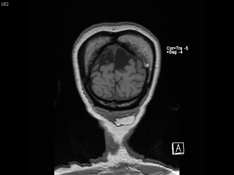 File:Atypical meningioma - intraosseous (Radiopaedia 64915-74572 Coronal T1 182).jpg