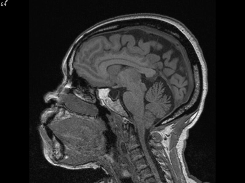 File:Atypical meningioma - intraosseous (Radiopaedia 64915-74572 Sagittal T1 84).jpg