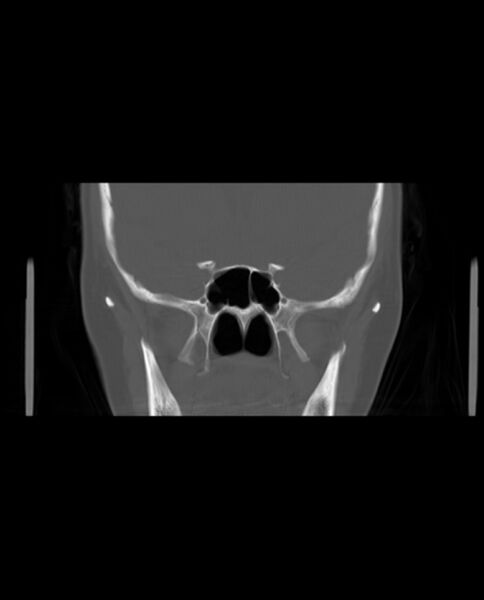 File:Automastoidectomy with labyrinthine fistula (Radiopaedia 84143-99411 Coronal non-contrast 60).jpg