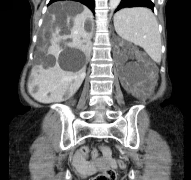 File:Autosomal dominant polycystic kidney disease (Radiopaedia 16777-16490 B 33).jpg