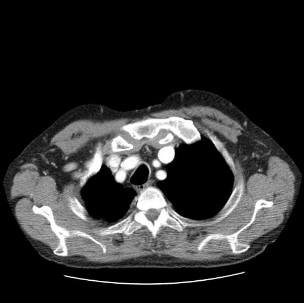 File:Autosomal dominant polycystic kidney disease (Radiopaedia 27851-28094 B 10).jpg