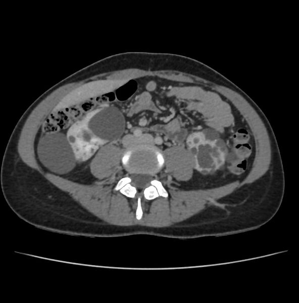 File:Autosomal dominant polycystic kidney disease - early onset (Radiopaedia 40734-43387 A 52).jpg