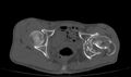 Avascular necrosis of the left hip (Radiopaedia 75068-86125 Axial bone window 53).jpg