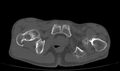 Avascular necrosis of the left hip (Radiopaedia 75068-86125 Axial bone window 80).jpg