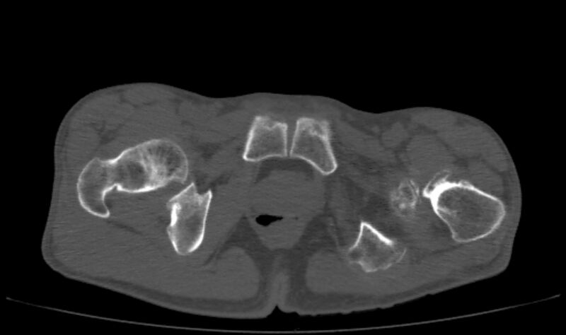 File:Avascular necrosis of the left hip (Radiopaedia 75068-86125 Axial bone window 80).jpg