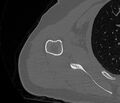 Avulsion fracture - greater tuberosity of humerus (Radiopaedia 71216-81514 Axial bone window 54).jpg
