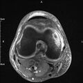 Avulsion fracture of the fibular head (Radiopaedia 74804-85808 Axial PD fat sat 19).jpg