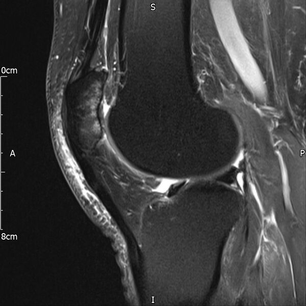 File:Avulsion fracture of the fibular head (Radiopaedia 74804-85808 Sagittal PD fat sat 21).jpg