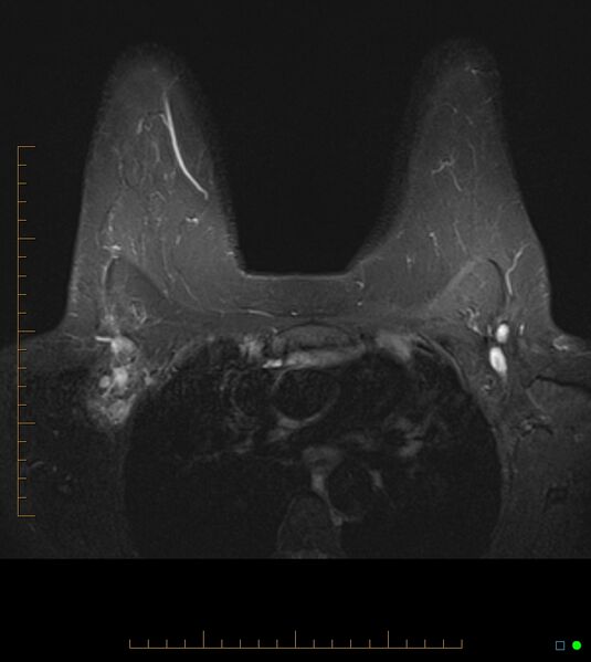 File:Axillary lymphadenopathy on breast MRI- yellow fever vaccination induced (Radiopaedia 19454-19483 Axial T2 fat sat 7).jpg