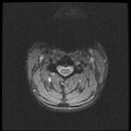 Axis fracture - MRI (Radiopaedia 71925-82375 Axial T2 fat sat 10).jpg
