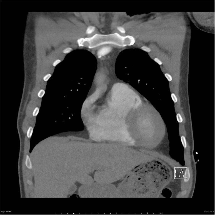 Azygos venous system anatomy (CT pulmonary angiography) (Radiopaedia 25928-26077 Coronal C+ CTPA 20).jpg